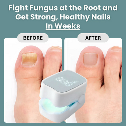 Toenail fungus before and after results with ClearNail Pro nail fungus laser device after consistent use